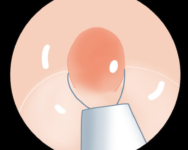 日帰りポリープ